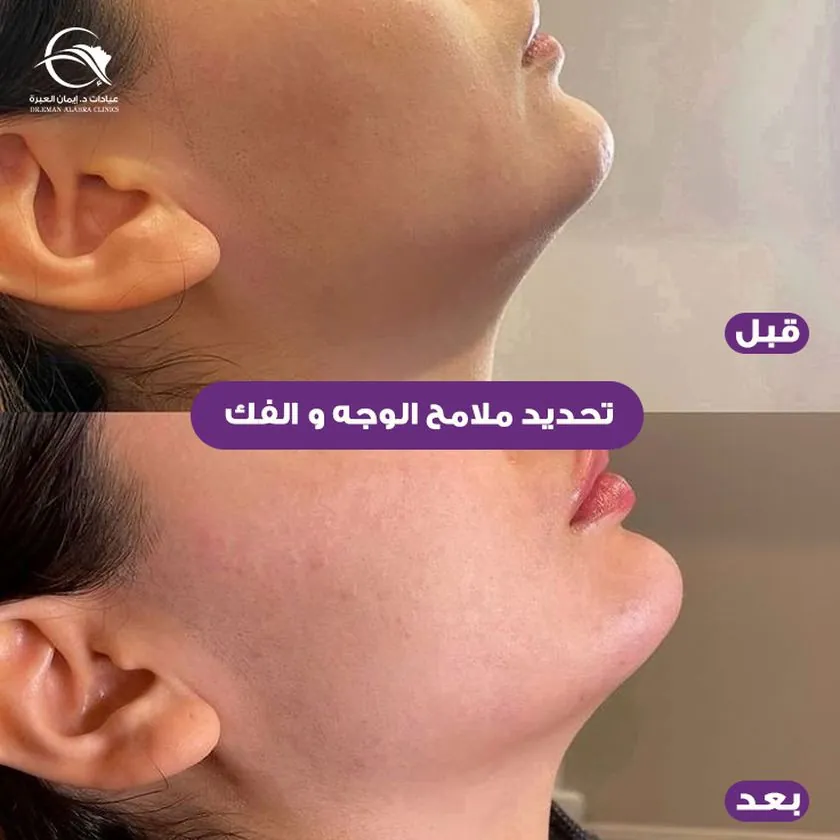 تحديد ملامح الوجه والفك