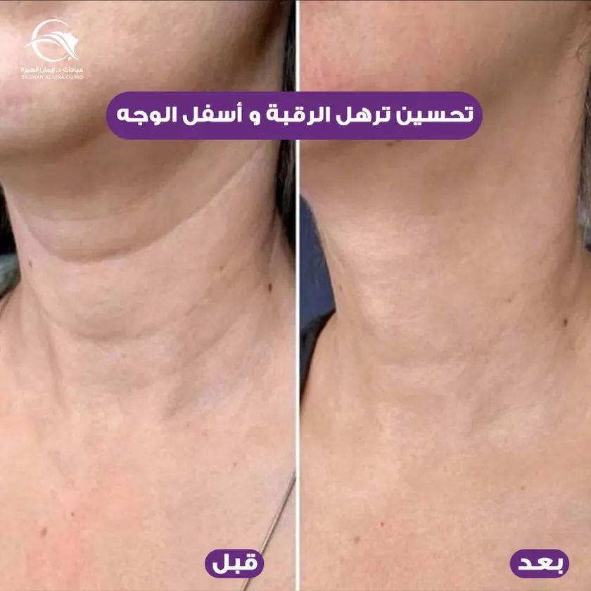 تحسين ترهل الرقبة وأسفل الوجه