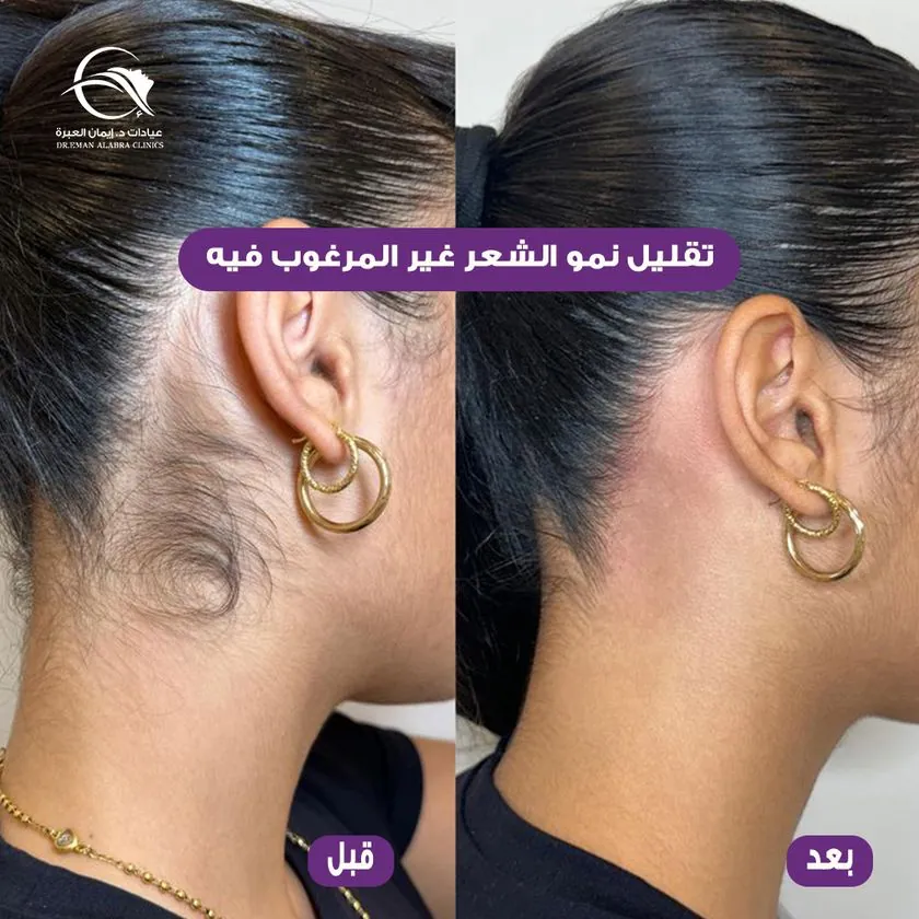 تقليل نمو الشعر غير المرغوب فيه