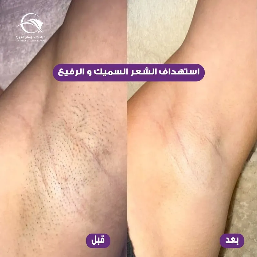 استهداف الشعر السميك والرفيع