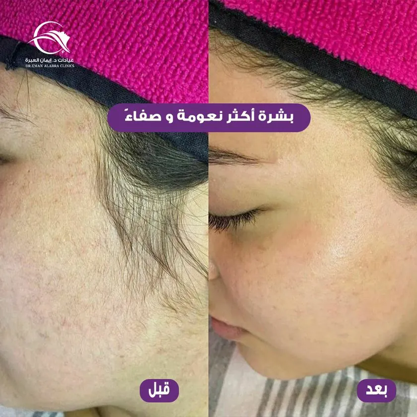 بشرة أكثر نعومة وصفاءً