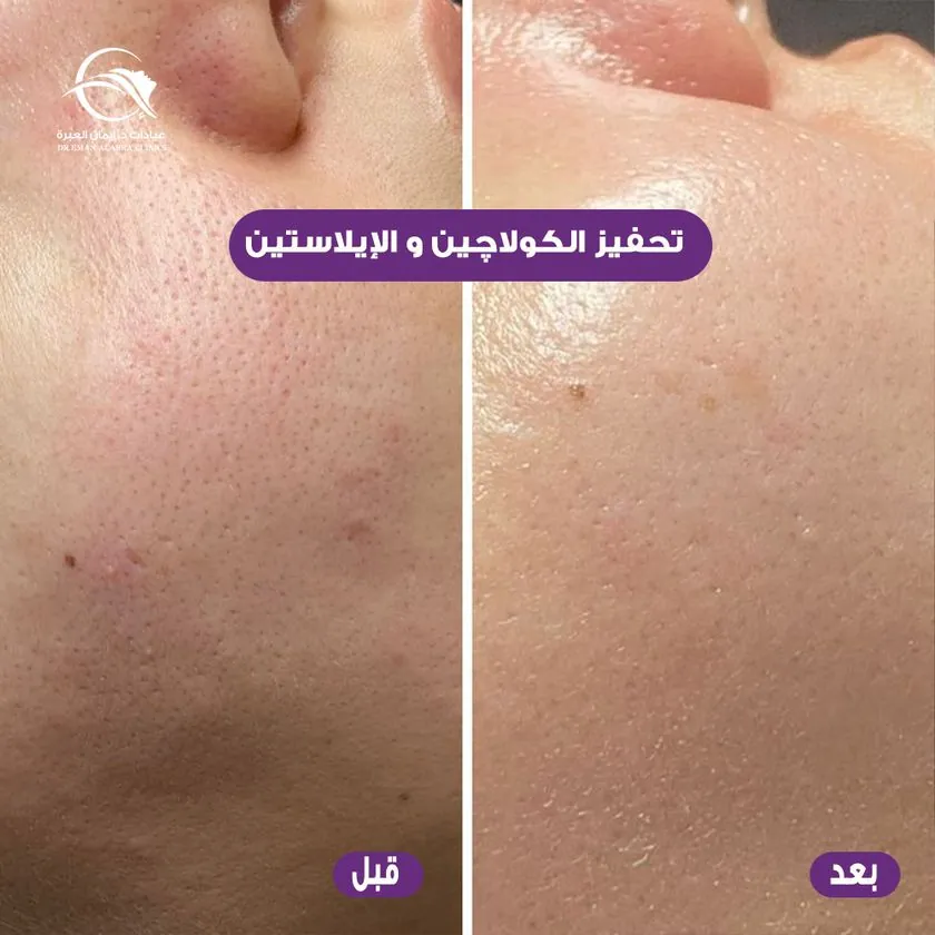 تحفيز الكولاجين والإيلاستين
