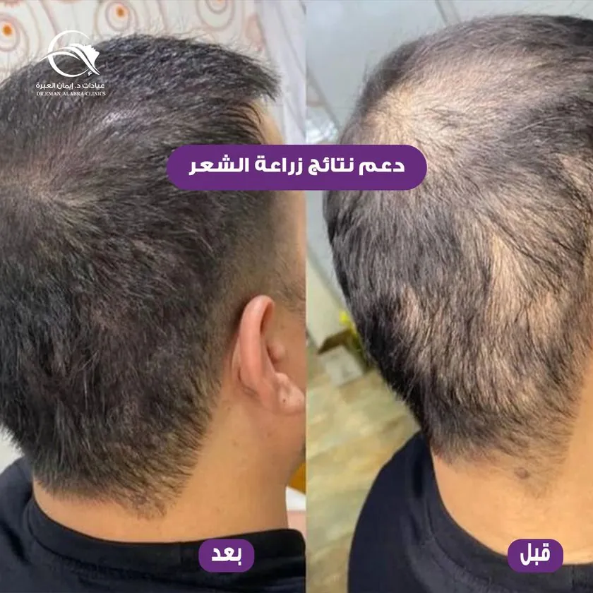 دعم نتائج زراعة الشعر