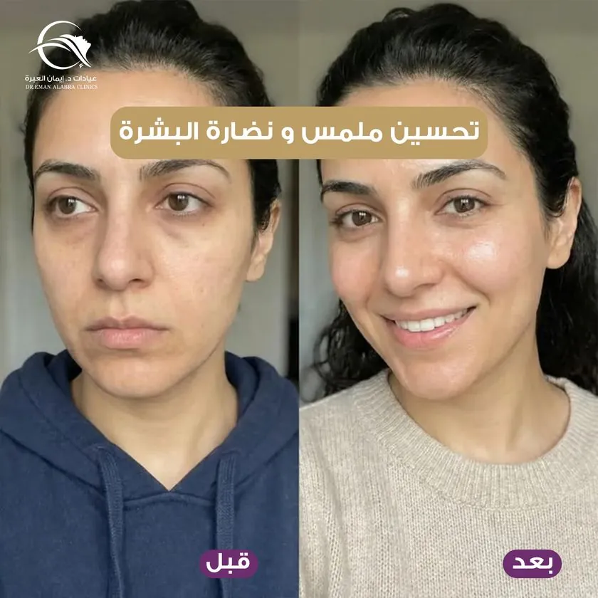 تحسين ملمس ونضارة البشرة