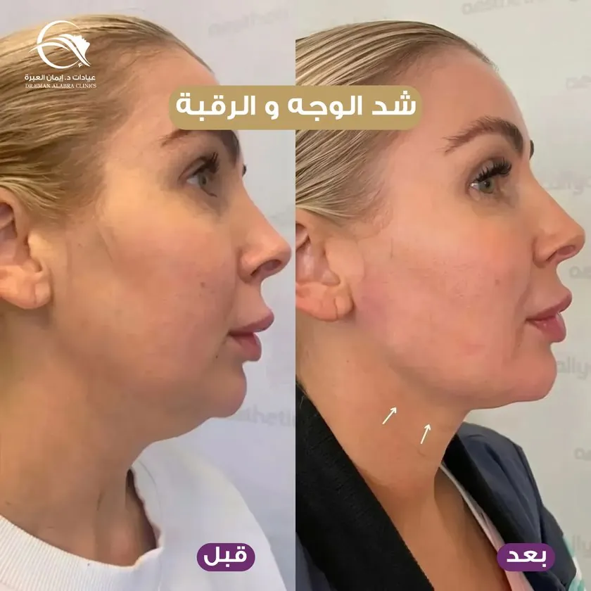 شد الوجه والرقبة