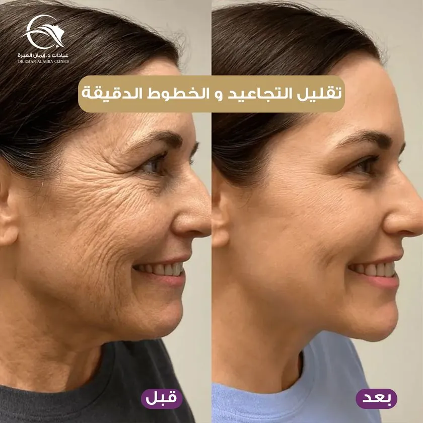 تقليل التجاعيد والخطوط الدقيقة