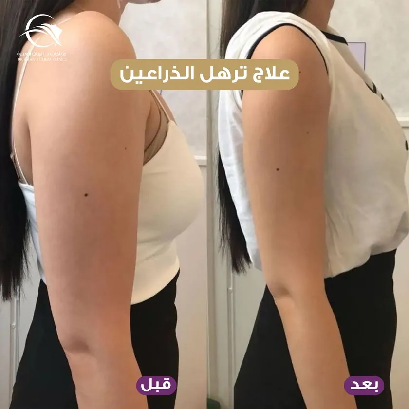 علاج ترهل الذراعين