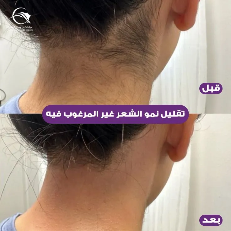 تقليل نمو الشعر غير المرغوب فيه